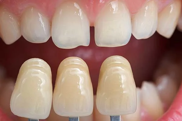 Tooth shade guide being held up to teeth