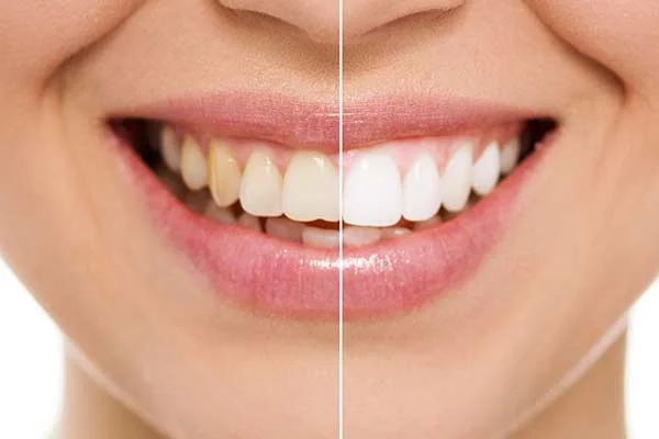 Before and after photo showing teeth whitening
