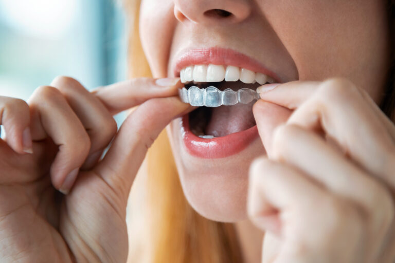 Woman wearing orthodontic silicone trainer. Invisible braces ali