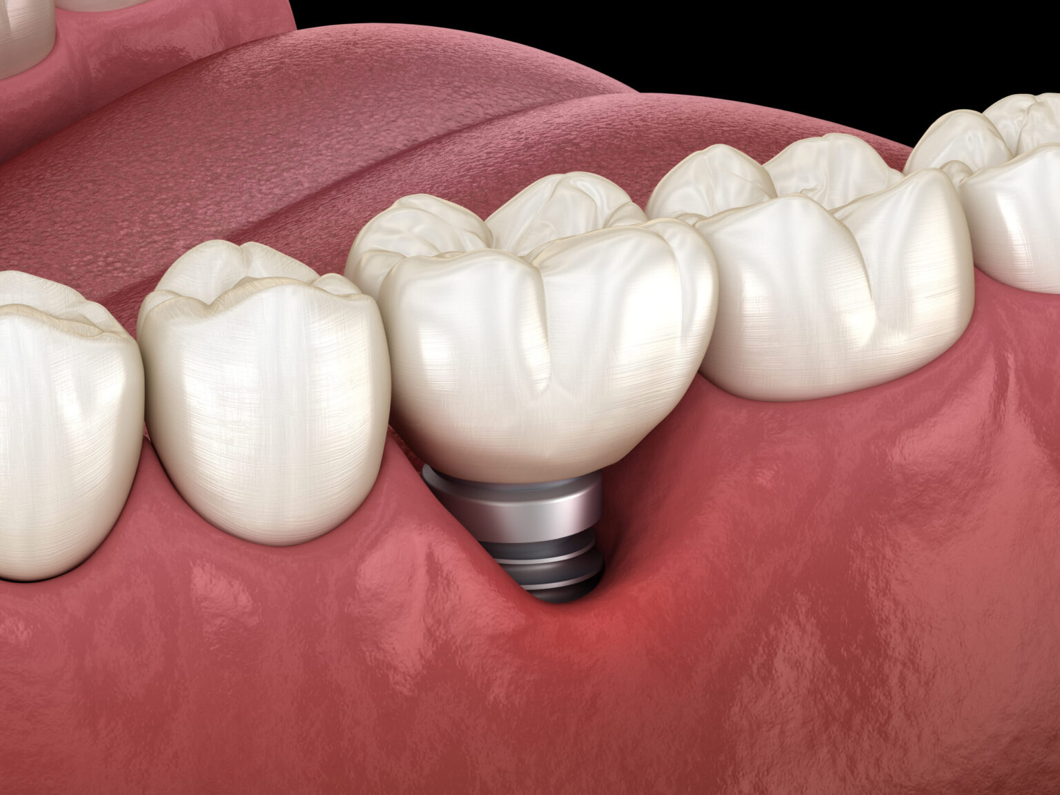 Peri-implantitis with visible gum recession. Medically accurate 3D illustration of dental implants concept