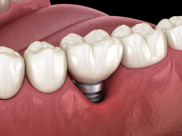 Peri-implantitis with visible gum recession. Medically accurate 3D illustration of dental implants concept