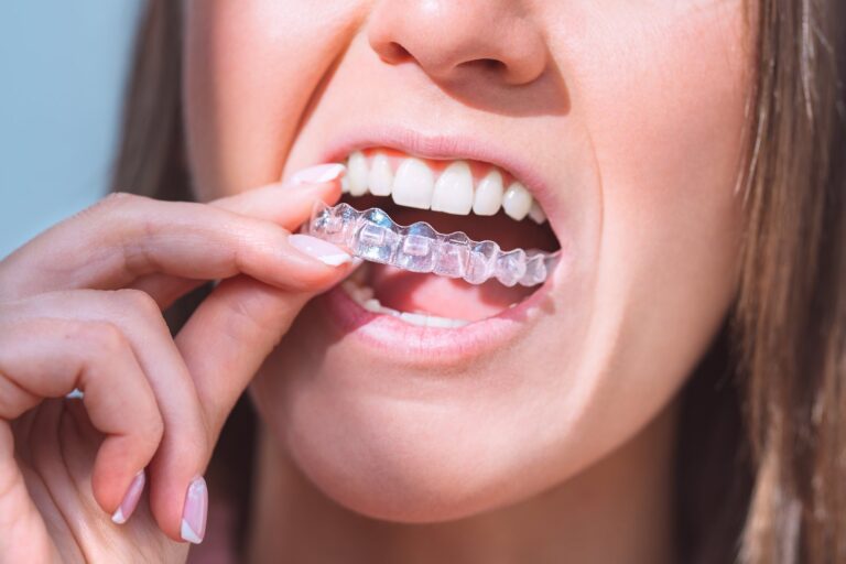Woman with a straight, healthy smile inserting a clear Invisalign aligner