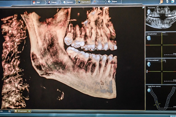 Cone Beam 3D x-ray Image