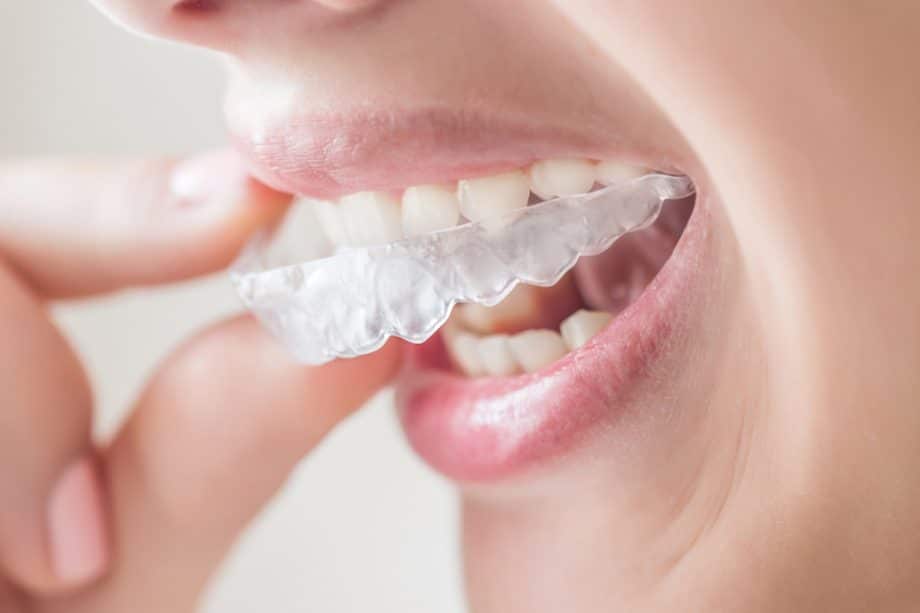 How Much Does Invisalign Cost in Huntersville, NC?