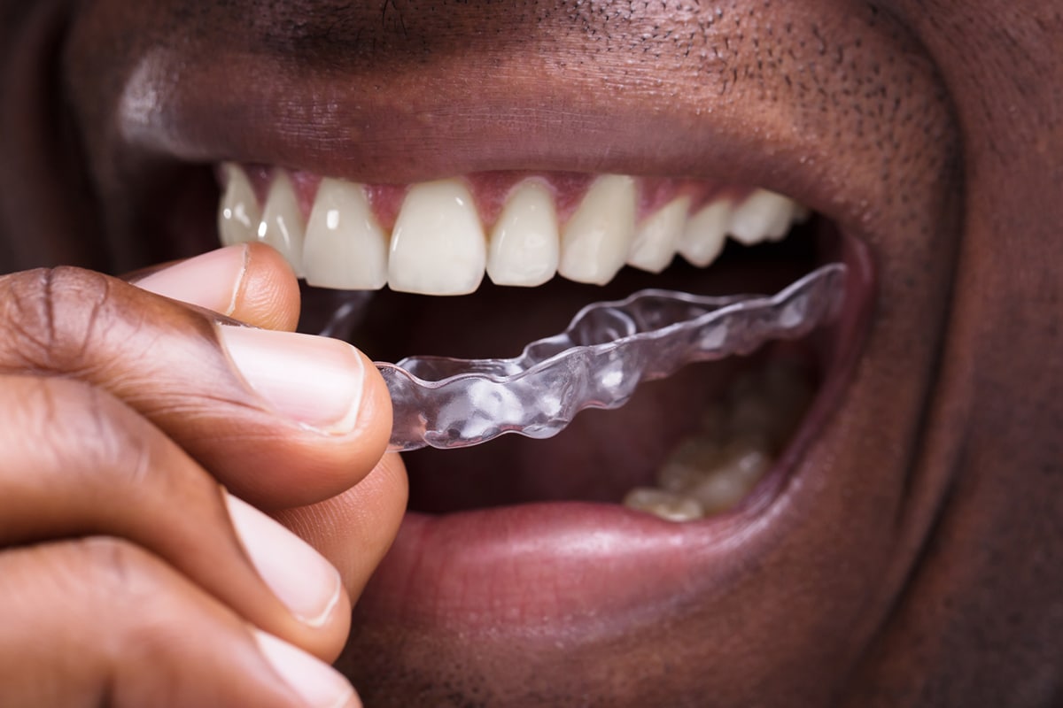 How Much Does Invisalign Cost in Huntersville, NC?