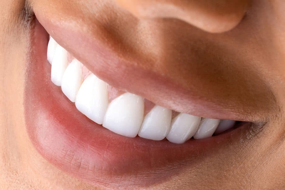 Teeth Whitening vs. Veneers: Which Is Right for You?