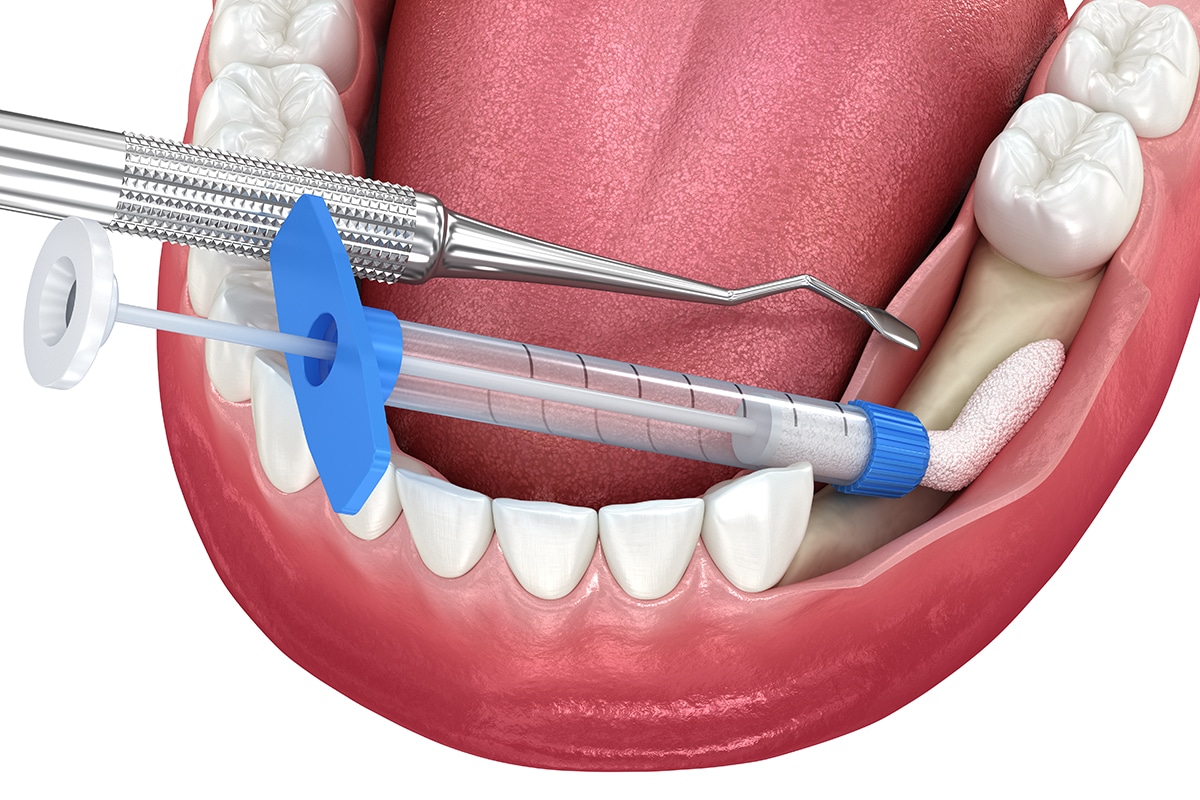 What Does Bone Grafting Cost Before Dental Implants?